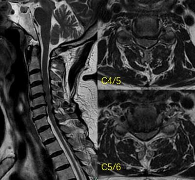 Case Report: Bilateral Biportal Endoscopic Open-Door Laminoplasty With the Use of Suture Anchors: A Technical Report and Literature Review